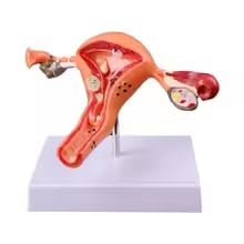 Pathological Uterus & Ovary Model - Female Reproductive Anatomy Model Teaching Aids for Medical Education Classroom Demonstrations Doctor's Offices & Anatomy Study
