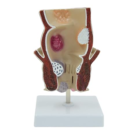 Colon Anus Sphincter Specimen, Human Rectal Pathological Anatomy Model, Anatomically Accurate, for Medical Research Teaching Display