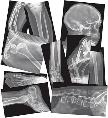 Roylco Broken Bones X-Ray Set, Projector Display Compatible, 15 X-Rays